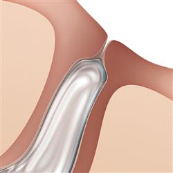FORM FIT® Hydrogel Intracanalicular Plug by OASIS®